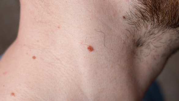 Datorprogram lika effektivt som läkare på att diagnostisera hudcancer